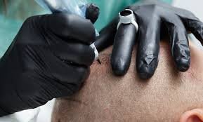 Scalp micropigmentation for hair loss by Nancy Akbari