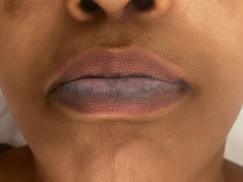 Lip-Correction-by-Nancy-Akbari-Cosmeticbybanou (1)