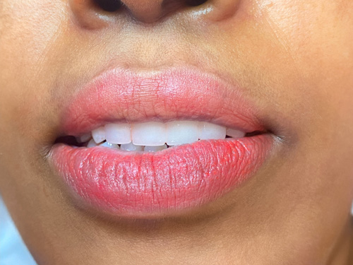 Lip-Correction-by-Nancy-Akbari-Cosmeticbybanou (2)