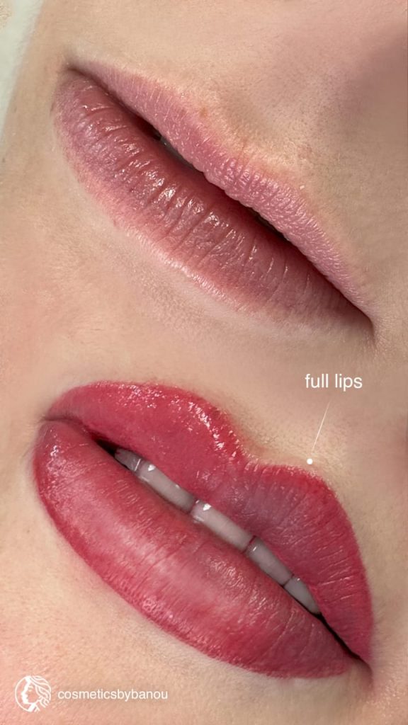 Full-Lips Transformation by Nancy Akbari Before & After Cosmeticbybanou