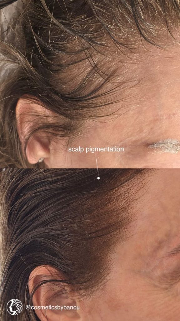Natural Scalp Pigmentation by Nancy Akbari Beverly Hills Cosmeticbybanou