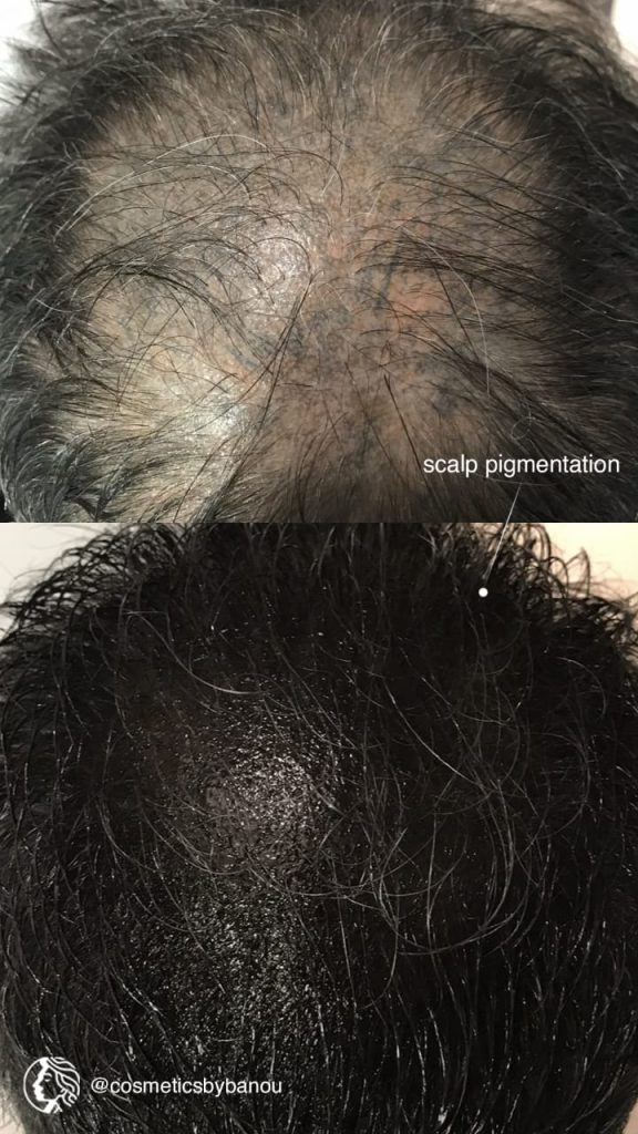 Scalp Micropigmentation for Hair Loss by Nancy Akbari Cosmeticbybanou
